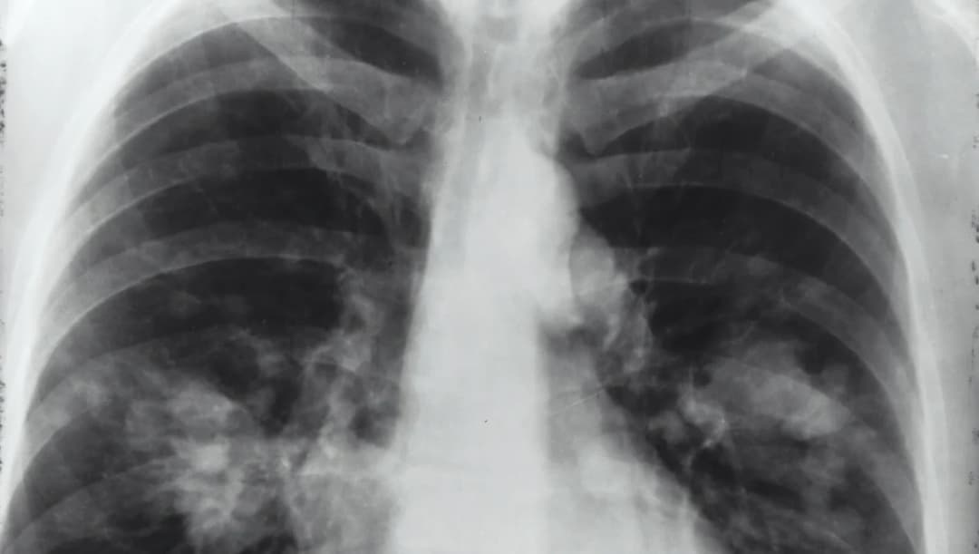 เช็กสัญญาณเตือน ‘มะเร็งปอด’ สาเหตุการเสียชีวิตอันดับ 2 ของคนไทย