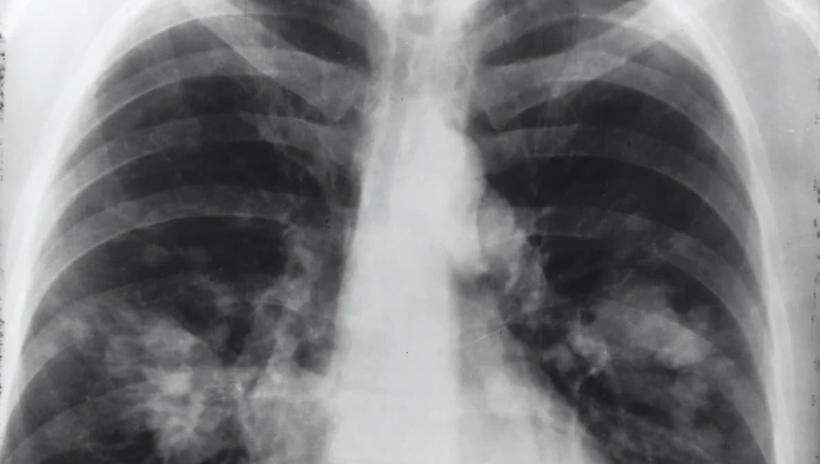 เช็กสัญญาณเตือน ‘มะเร็งปอด’ สาเหตุการเสียชีวิตอันดับ 2 ของคนไทย