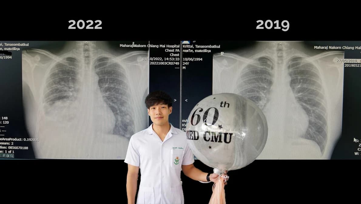 ชาวเน็ตส่งกำลังใจ หมอหนุ่มป่วยมะเร็งปอดระยะสุดท้าย แชร์เรื่องราวผ่านเพจ ‘สู้ดิวะ’