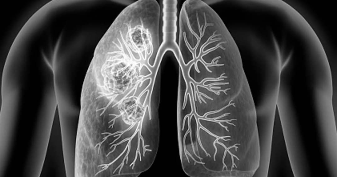 สถิติเก่า พบ ‘อ.สารภี จ.เชียงใหม่’ มีผู้ป่วยมะเร็งปอดและเสียชีวิตมากที่สุดของประเทศ