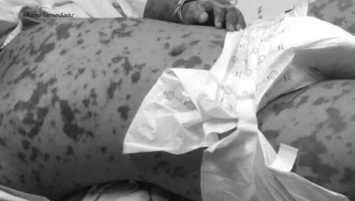 จับตา ‘ไข้กาฬหลังแอ่น’ จ.กระบี่ พบผู้ติดเชื้อ 6 ราย เสียชีวิตแล้ว 1 ราย