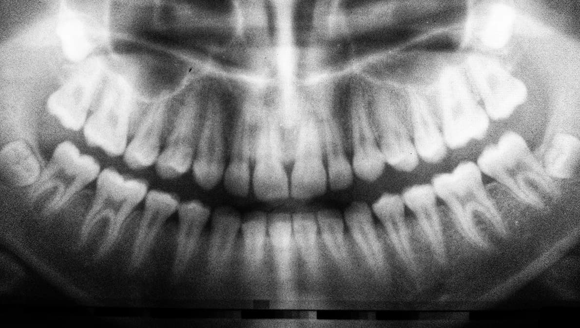 แรงงานถือบัตรประกันสังคม อย่าลืมใช้สิทธิ ทำฟันประจำปี วงเงิน 900 บาท