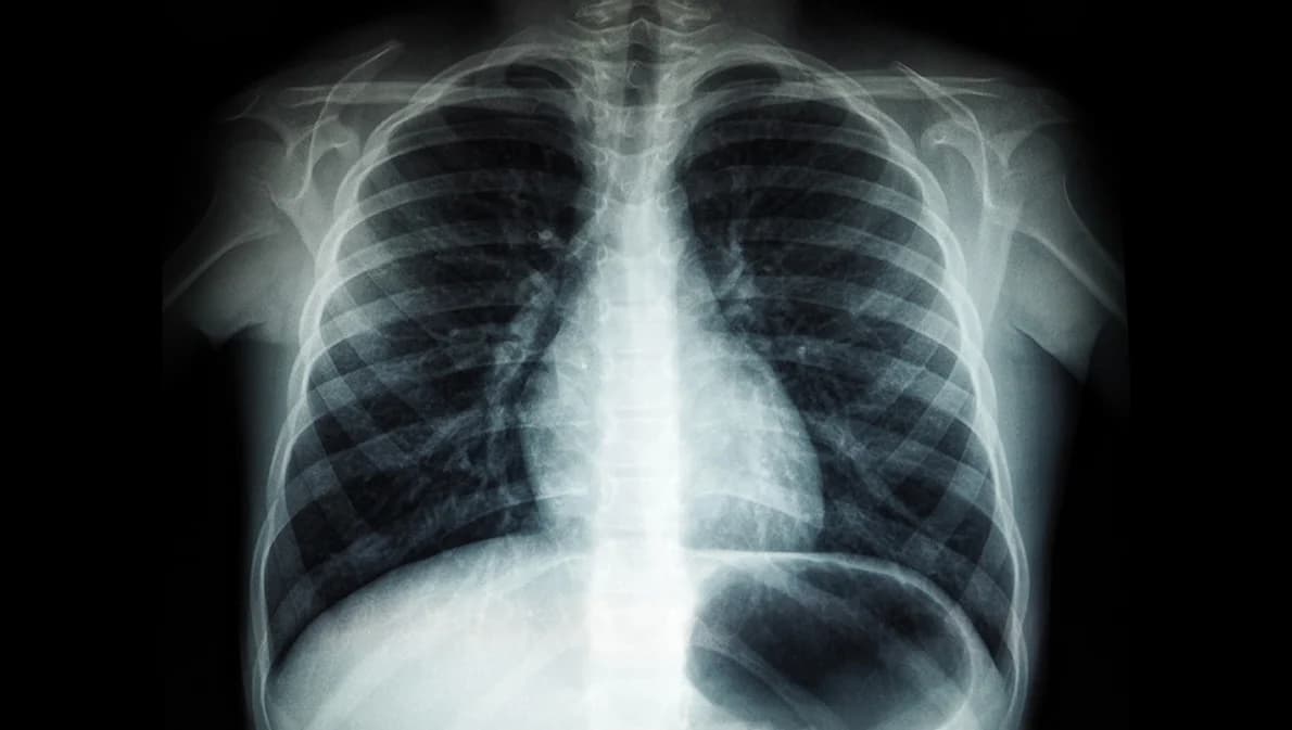 อย.แจงอนุมัติทะเบียนยารักษาวัณโรครวมเม็ดแล้ว 2 รายการ ตั้งแต่ ปี พ.ศ. 2564