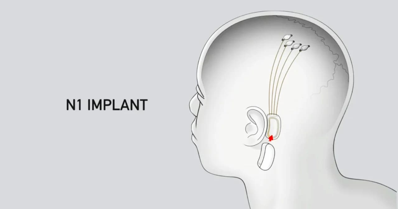 Neurallink ประสาทเทียมของ อีลอน มัสก์ ส่อชะงัก ด้วยเหตุความปลอดภัย อาจทำร้ายสมอง และทำให้ปนเปื้อน