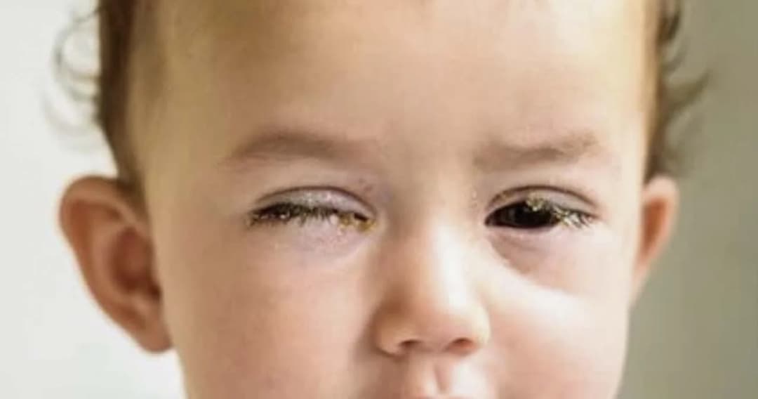 เช็กอาการสำคัญ เด็กที่ติดเชื้อสายพันธุ์ XBB.1.16 เยื่อบุตาอักเสบ ลืมเปลือกตาไม่ขึ้น แต่ไม่มีหนอง