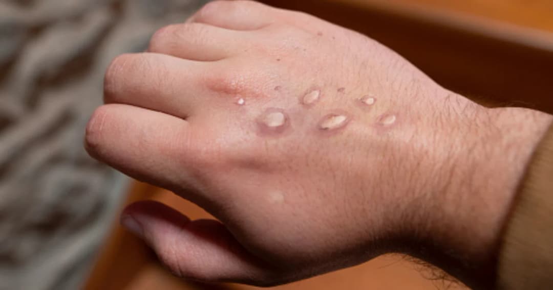 พบผู้ป่วยโรคฝีดาษวานร 9 รายปลายเดือนพฤษภาคม 66 เช็กอาการใครตกอยู่ในกลุ่มเสี่ยง