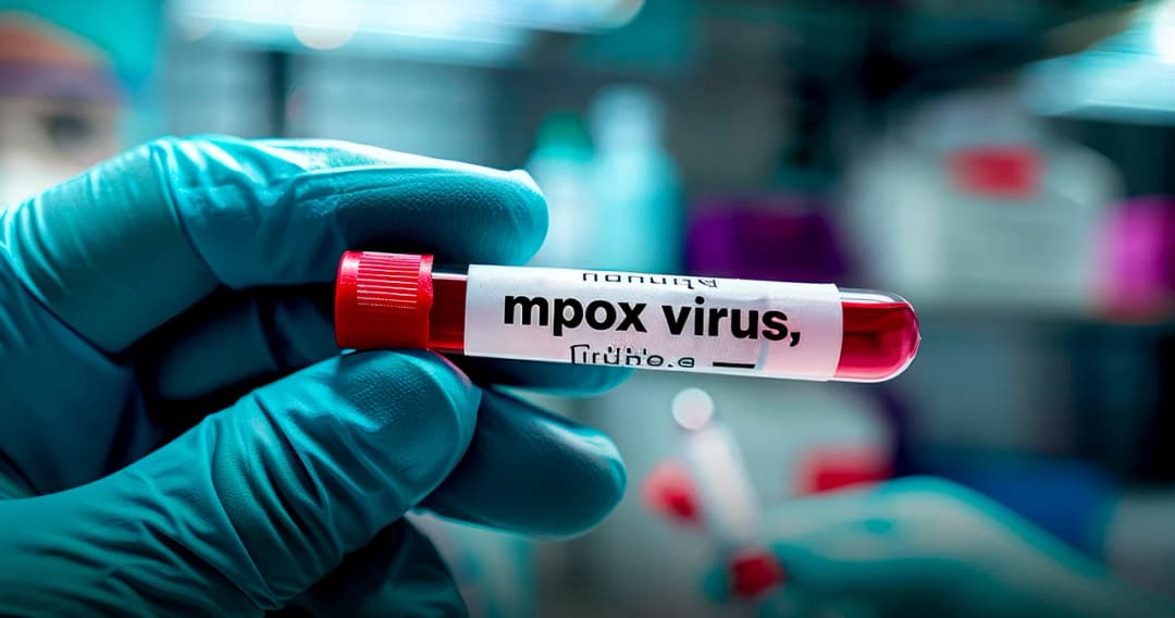 โรคฝีดาษวานร (MPox) หรือฝีดาษลิง