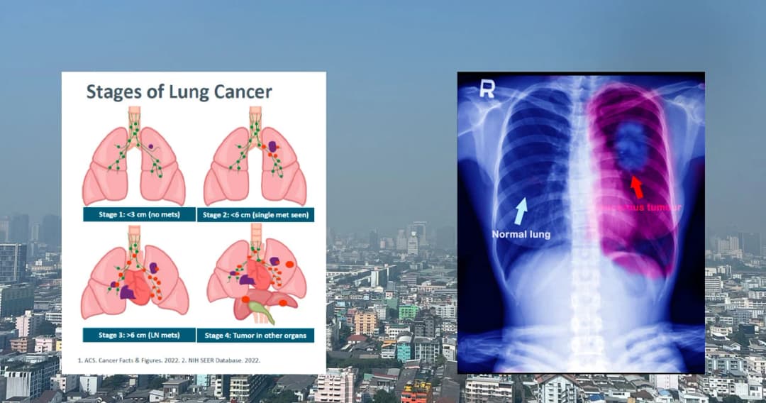 สถิติน่าตกใจ ! คนไทยเสียชีวิตจากมะเร็งปอดวันละ 40 ราย มากกว่าอุบัติเหตุทางถนน