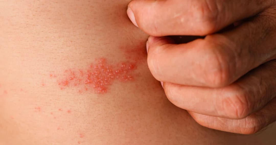 สูงวัยเสี่ยง “โรคงูสวัด” แนะฉีดวัคซีนก่อนเกิดอาการรุนแรง-ภาวะแทรกซ้อน