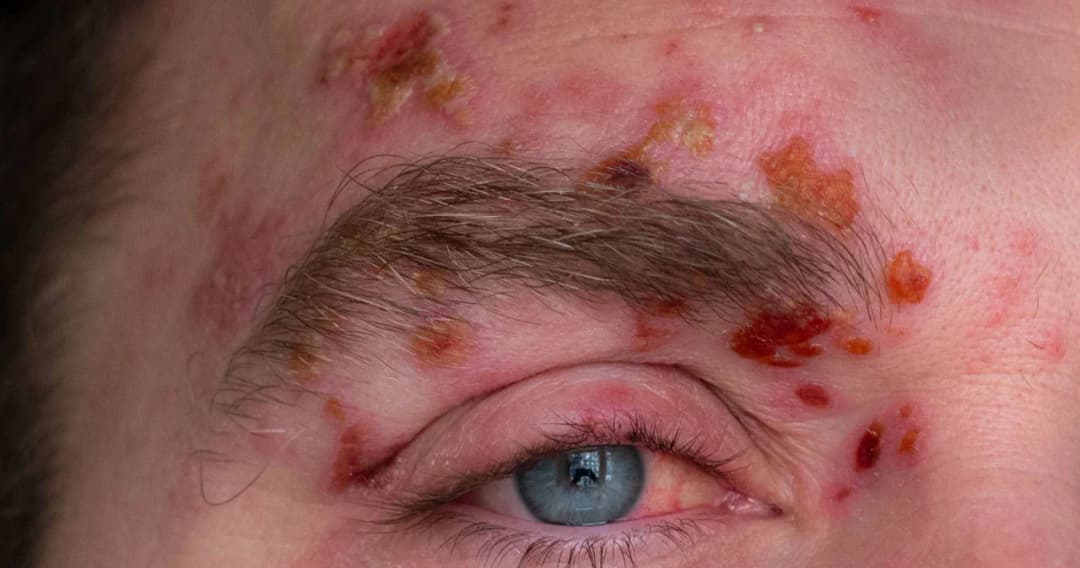 โรคงูสวัด อันตรายกว่าที่คิด แพทย์ย้ำอายุ 50+ และมีโรคร่วมเสี่ยงปัญหาสุขภาพร้ายแรง