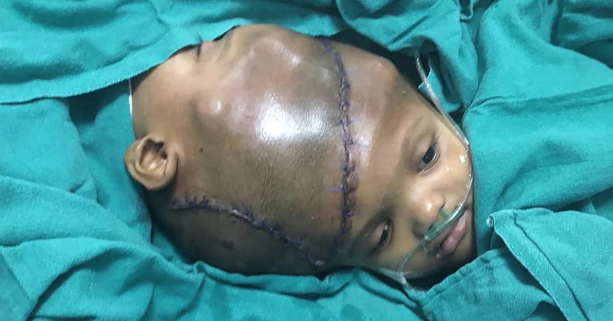 ทีมแพทย์กว่า 60 ชีวิตผ่าแยกศีรษะแฝดที่ใช้อวัยวะร่วมกันได้สำเร็จ ใช้เวลากว่า 36 ชม.