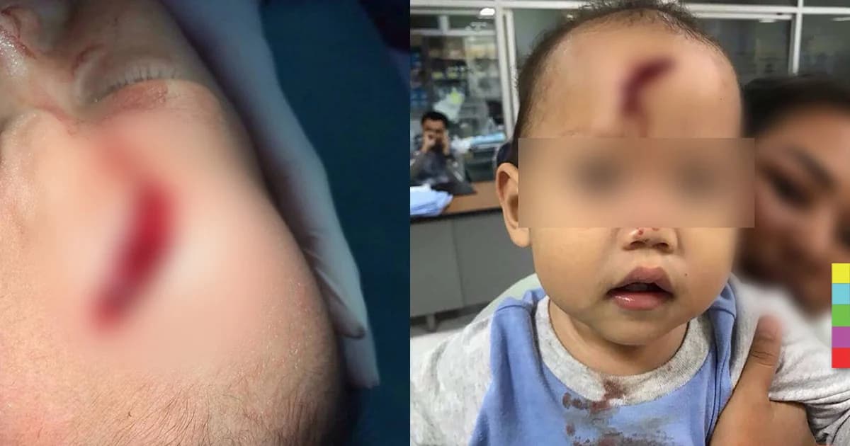 แม่โพสต์เตือน พี่เลี้ยงทำหัวลูกแตกเย็บหลายเข็ม อ้างเด็กตกเปล