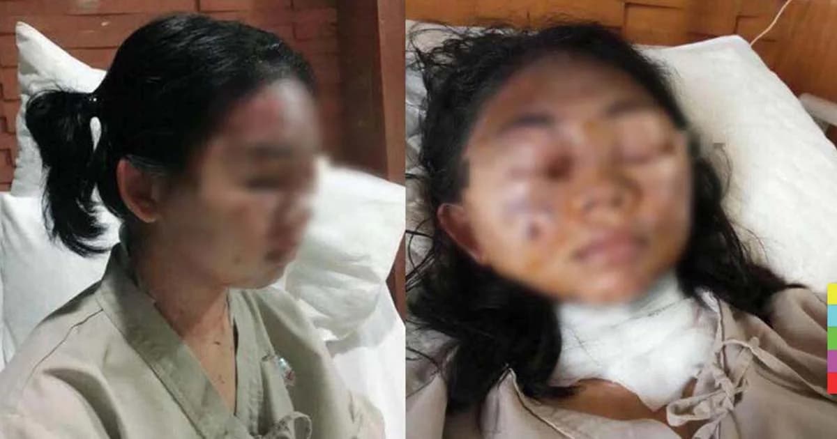 กนอ.จ่อเอาผิดบริษัทสั่งปิดข่าว เหตุเตาน้ำมันระเบิดใส่หน้า นศ.ฝึกงาน