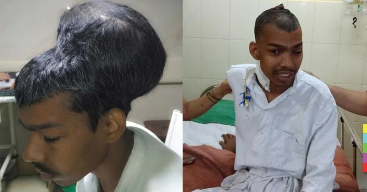 แพทย์อินเดียผ่าก้อนเนื้อสมองใหญ่ที่สุดในโลกสำเร็จ