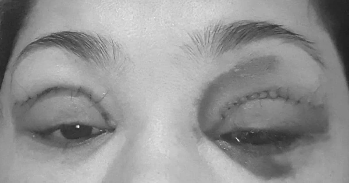 ‘คลินิกห้างดัง’ ศัลยกรรมตาเลือดคั่ง เผย ‘คนเย็บไม่ใช่หมอ’