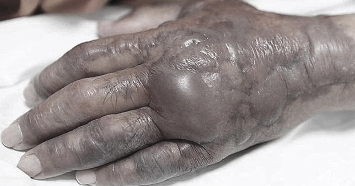 ‘ชายชาวเกาหลี’ กินปลาดิบ ติดเชื้อแบคทีเรีย จนต้องตัดมือทิ้ง!