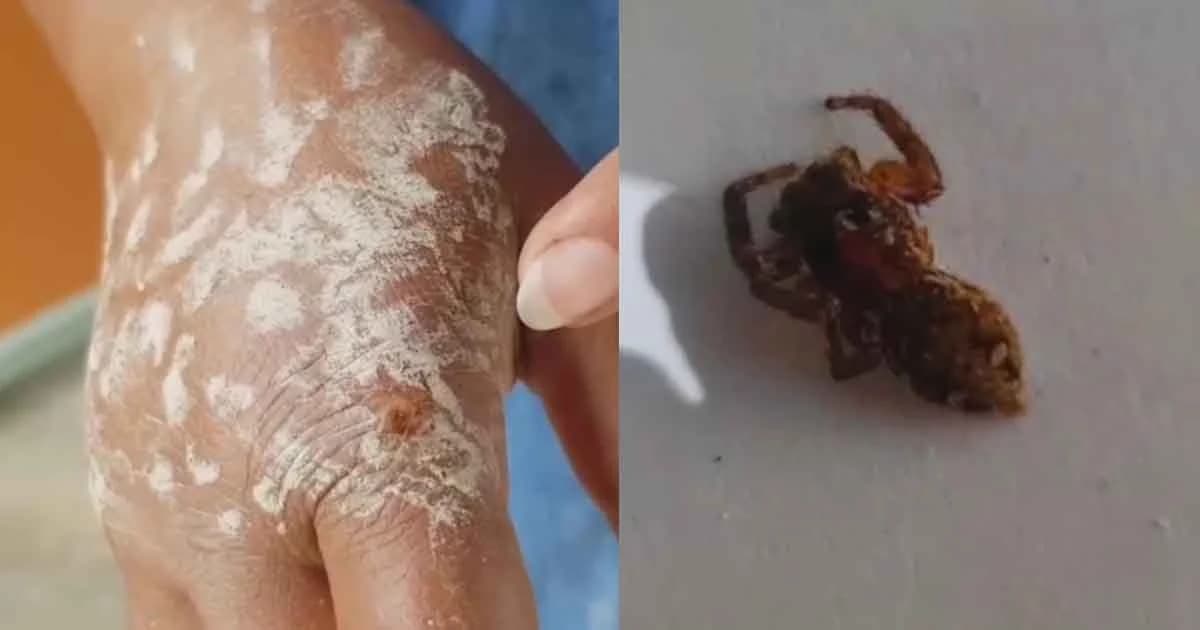 หญิงวัย 47 ถูกแมงมุมกัด แผลไหม้บวมทั้งมือ รักษานานกว่าสัปดาห์ไม่หาย