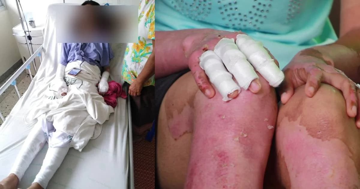 สั่งตั้งกรรมการสอบครู สั่งสาว ม.6 เผาน้ำส้มควันไม้แก้เกรดวิชาฟิสิกส์ จนถูกไฟคลอก