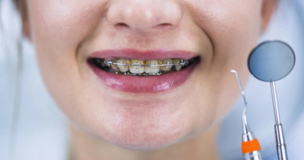 เตือน จัดฟันแฟชั่นในคลินิกเถื่อน เสี่ยงติดเชื้ออันตรายถึงชีวิต