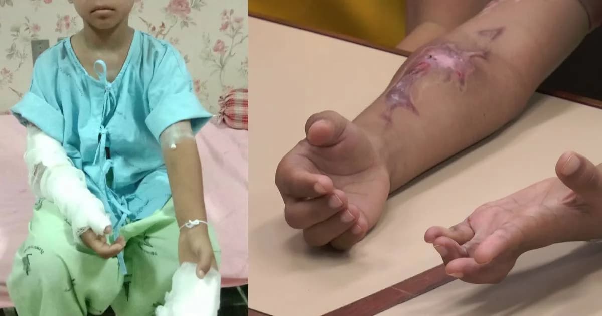 แม่ ด.ช.วัย 10 ขวบ ร้องอดีต ผอ.ใช้งานลูกหิ้วถังยางมะตอยร้อนลวกแขนเสี่ยงพิการ