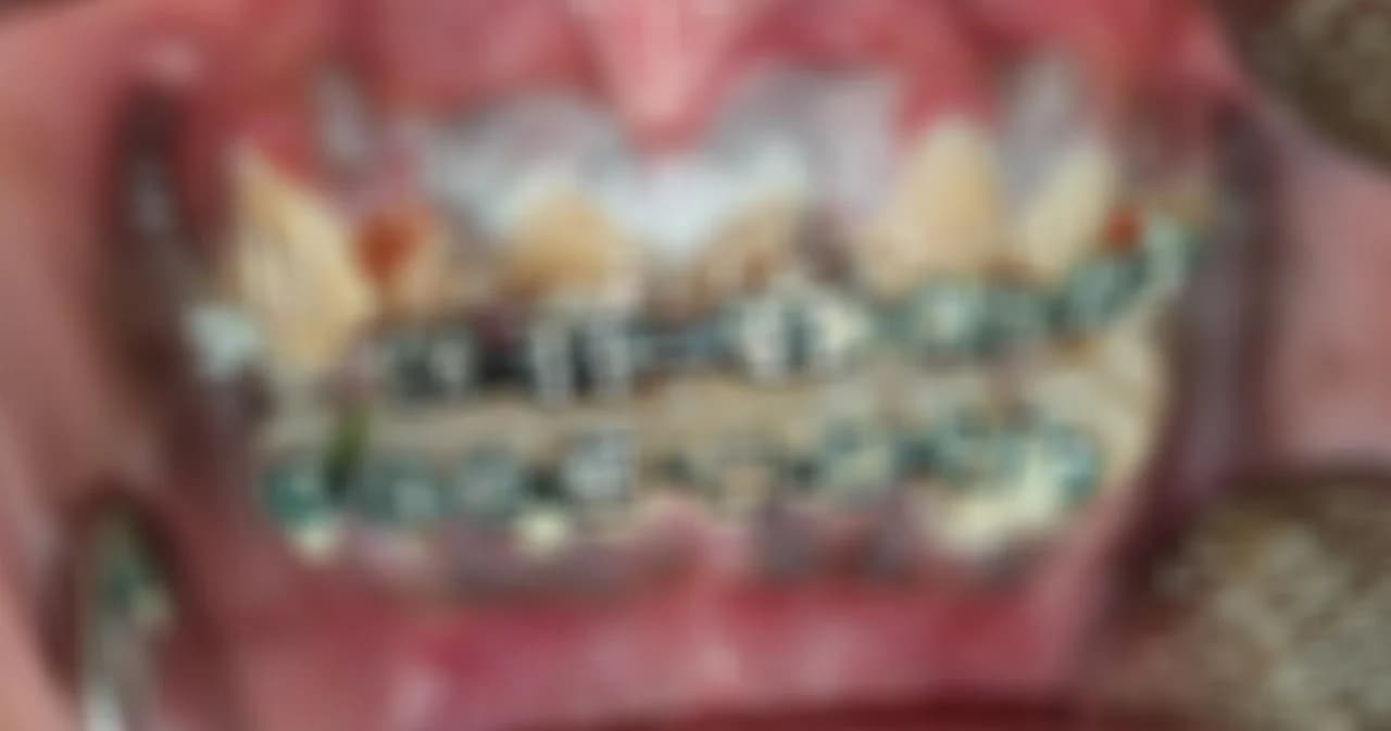 อันตรายจัดฟันแฟชั่นฟันผุทั้งปากหมอต้องถอนฟันทิ้ง