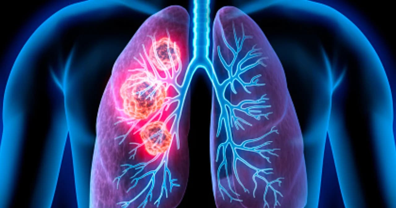 เปิดงานวิจัยด้านมะเร็งปอด เผยวิธีตรวจพบโรคเร็วขึ้น ช่วยเพิ่มโอกาสรอดชีวิต