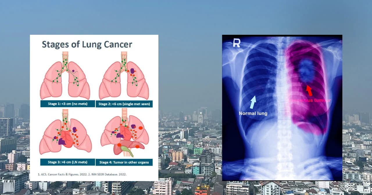 สถิติน่าตกใจ ! คนไทยเสียชีวิตจากมะเร็งปอดวันละ 40 ราย มากกว่าอุบัติเหตุทางถนน
